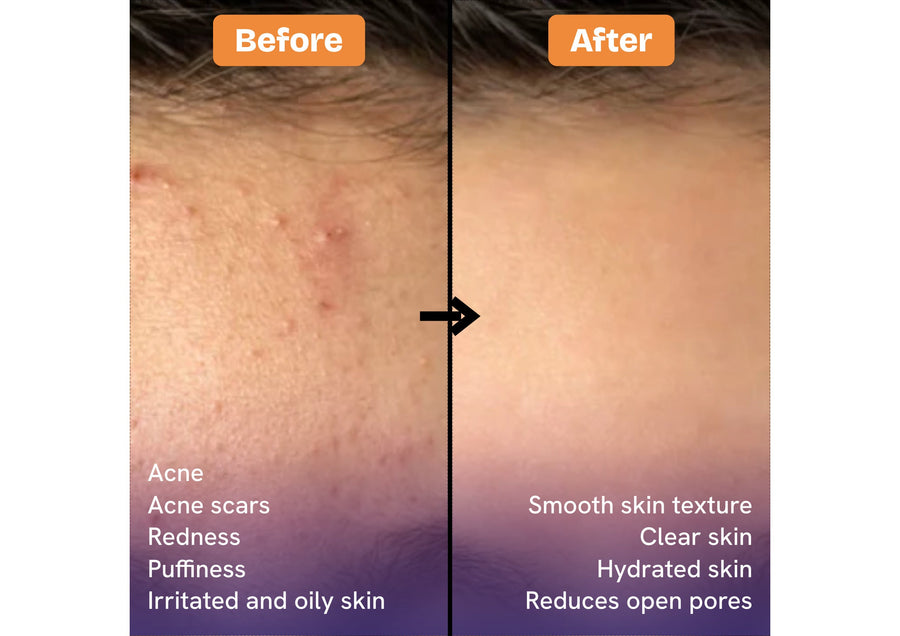 Before-and-after skin comparison showing a close-up of a person's forehead, with the top half labeled 'After' showing smoother skin and the bottom half labeled 'Before' showing acne and redness. Text on the right lists skin benefits, and text on the left labels the sections.