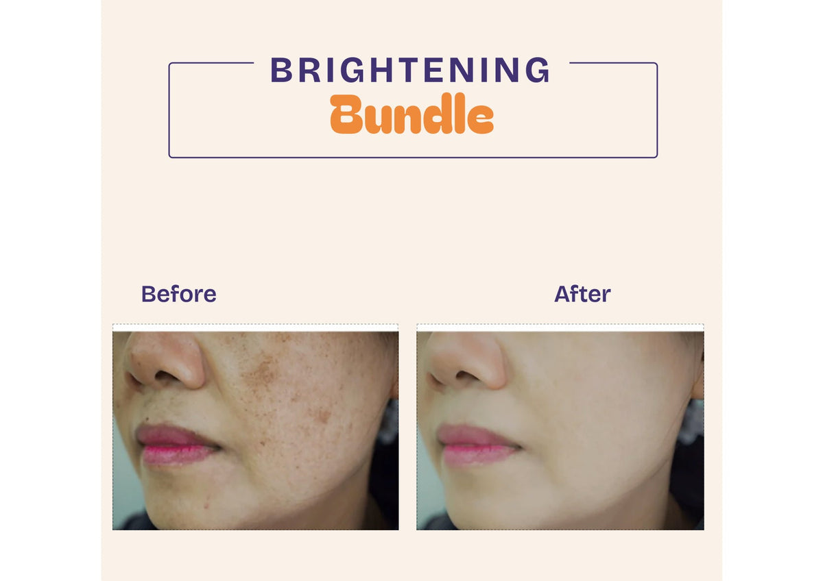 Promotional graphic for a 'BRIGHTENING Bundle' showing before-and-after close-up photos of a person's face, demonstrating skin brightening results. The left side features the text 'BRIGHTENING Bundle' in purple and orange on a light beige background, while the right side displays the 'After' and 'Before' comparison images.