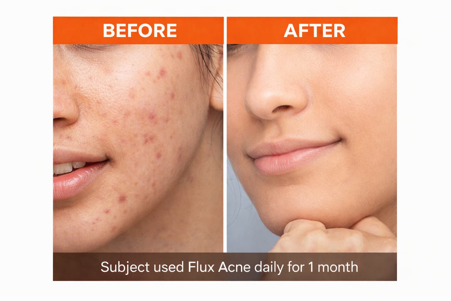 Flux Acne Free Clarifying Serum (30ml)