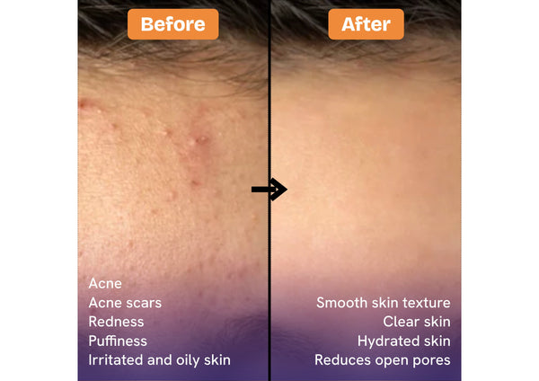 Before-and-after skin comparison showing a close-up of a person's forehead, with the top half labeled 'After' showing smoother skin and the bottom half labeled 'Before' showing acne and redness. Text on the right lists skin benefits, and text on the left labels the sections.
